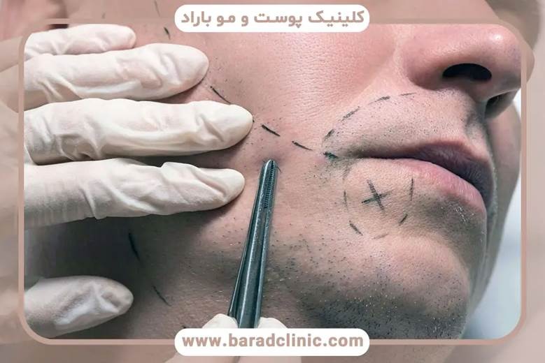 عوارض و ریسکهای احتمالی کاشت ریش با روش FUE